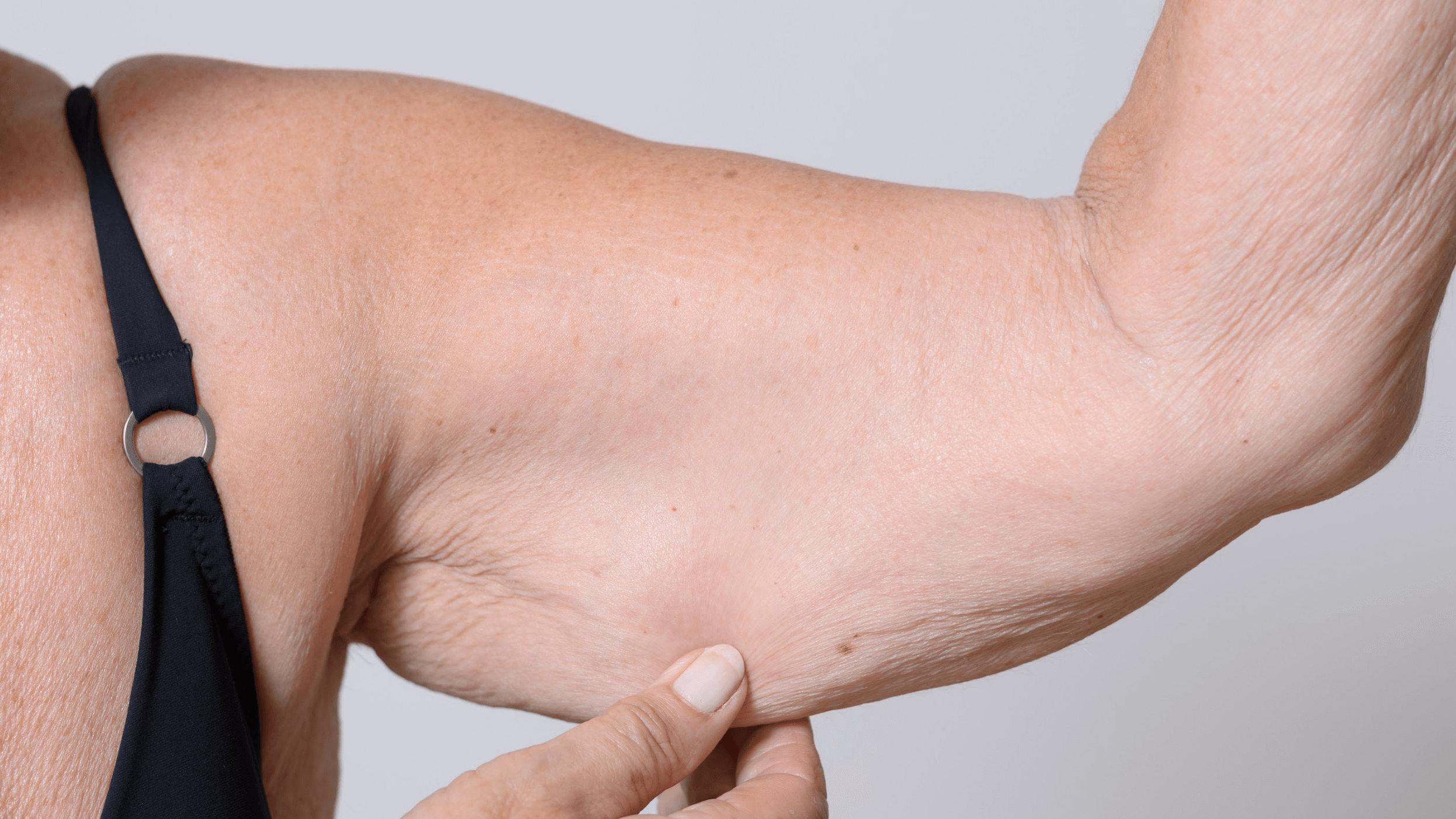 Fight the Bat Wing: How Laser Lipo Can Slim Your Arms - Vargas
